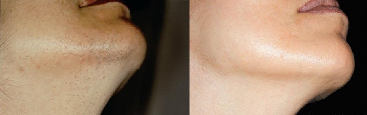 Barba de mujer antes y despues de depilar