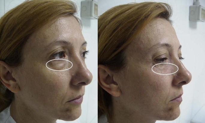 Radiofrecuencia facial