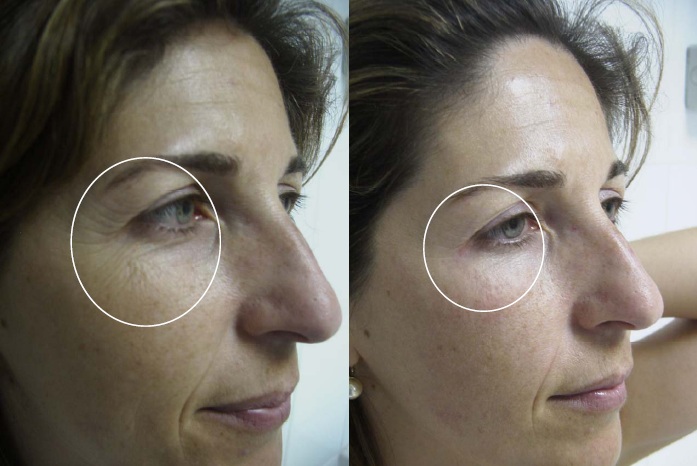 Radiofrecuencia facial