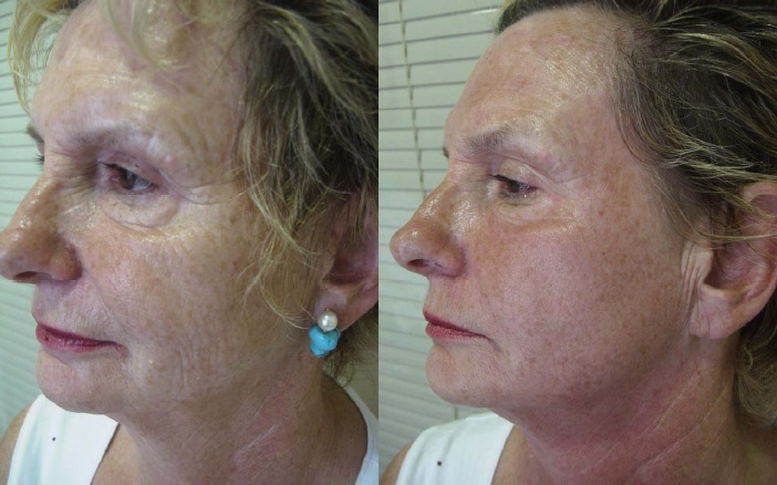 Radiofrcuencia facial