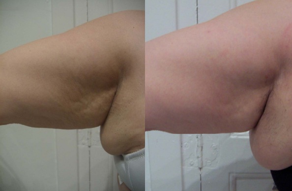 Radiofrecuencia brazo