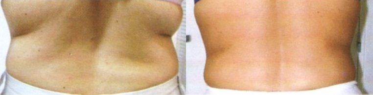 Radiofrecuencia espalda lumbares